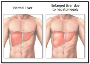 enlarged liver, liver enlargement